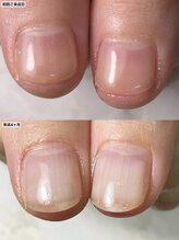 プレシャスハート 広島(Precious Heart)/自爪育成経過写真