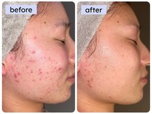 ニキビ/赤ら顔に人気の【剥けないハーブピーリング】陶器肌へ