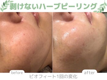 メイリリー 新宿(Meilily)/剥けないハーブピーリング