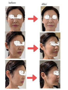 スキャニング@ラボエステ/輪郭矯正たるみ引き上げコース