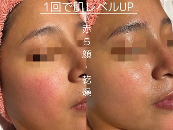 ビューティーサロンリア 栄 伏見店(LI'A)/アンストレス施術前後のお写真