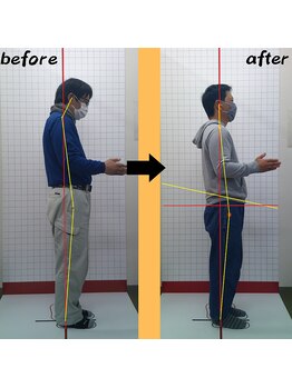 ほねつぎ 荒川沖はりきゅう接骨院/姿勢の変化2