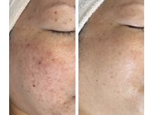 クラウドナイン(CLOUD NINE)/ビフォアアフター（シミケア）