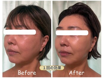 サロンドモモ(SALON de MOMO)の写真/フラクショナルRFでたるみ改善!点状照射で真皮層にアプローチし、ハリ肌へ導くケア♪