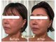サロンドモモ(SALON de MOMO)の写真/フラクショナルRFでたるみ改善!点状照射で真皮層にアプローチし、ハリ肌へ導くケア♪