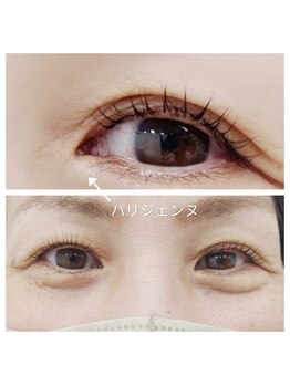 ネオビューティー(Neo beauty)/パリジェンヌ