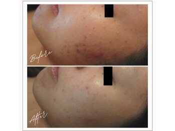 ミューベル(MYubelle)/ニキビ毛穴ケア 水光ピーリング