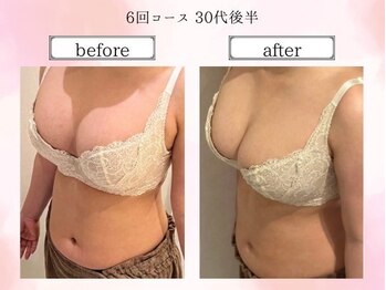 リール 恵比寿店(RIRE)/バストアップ症例【広尾恵比寿】