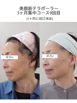 キューティ(Cutie)/テラボーラー　ビフォーアフター