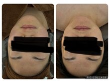 クオーレ(cuore)/レモンボトルビフォーアフター