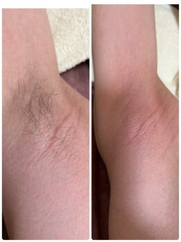 ルーメ(lume)/キッズ脱毛中学生男の子