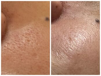 フェリス(FELIZ)/非変性生プラセンタプラズマ導入