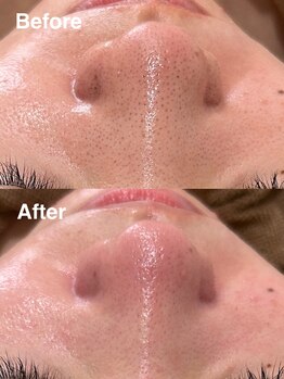 ミュー 岡崎店(mieux)/◇毛穴洗浄で劇的な変化！！