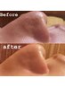 【ニキビ肌肌改善・毛穴引き締め☆】毛穴洗浄＋プラズマ