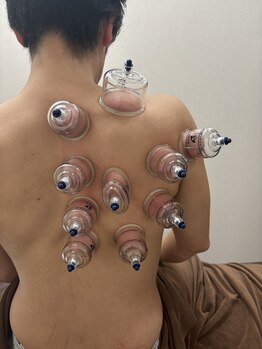 ほぐせる スター鍼灸接骨整体院 竹ノ塚 竹ノ塚東口駅前店/カッピング