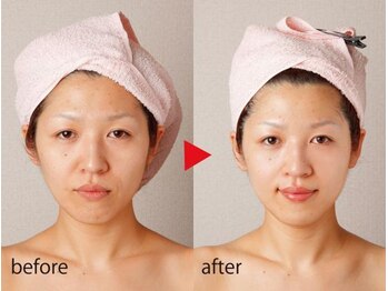 エステティックサロン アタラ/【光フェイシャル+小顔美矯正】