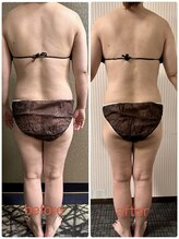 チュラ/ハイパーナイフ/所沢/痩身エステ