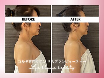 リスブランビューティー(Lys Blanc Beauty)/９０分コルギBefore×After