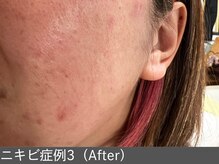 オアシスラグーン(OASIS LAGOON)/ニキビ改善（症例3 after）