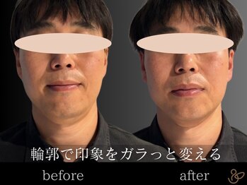 チョコバリ 恵比寿店(chocobari)/小顔リフトアップ（美容鍼）40代