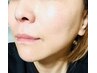 【人気No.2】30代～お試しケア！幹細胞上清液１A+エクソソームset毛穴シワ