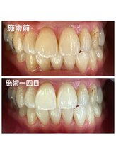リングベリー 湘南茅ヶ崎(Ring Beauty)/セルフホワイトニング施術例