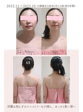 トゥインクル 麻布(twinkle)/麻布十番/シンメトリー小顔矯正