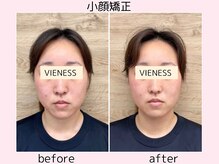 ヴィーネス(VIENESS)/【小顔矯正/整体/ヘッドスパ】