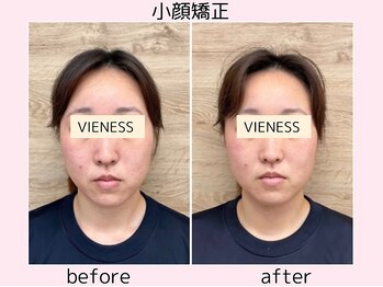 ヴィーネス(VIENESS)/【小顔矯正/整体/ヘッドスパ】