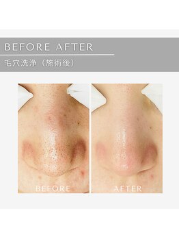 ジール(GIILL)/毛穴洗浄ビフォーアフター