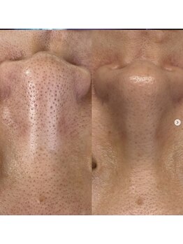 オウジエステサロン(OJIエステサロン)の写真/毛穴・凹凸肌に!王子駅エリアで希少なプロセルセラピーズ