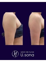 小顔・脂肪コントロール専門 salon de nurse U.sona～松本店～/【痩身】二の腕脂肪分解症例