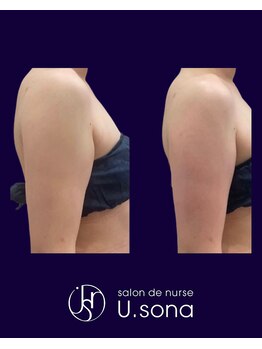 小顔・脂肪コントロール専門 salon de nurse U.sona～松本店～/【痩身】二の腕脂肪分解症例