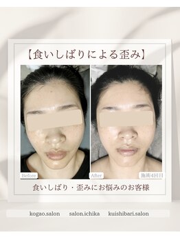 イチカ 仙川店( ichika)/食いしばりによる歪み左右差