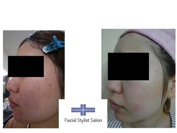 フェイシャルスタイリストサロン 高崎店(Facial Stylist Salon)/ケア例(65)
