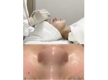リジュベネ(rejuvena)