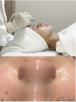 リジュベネ(rejuvena)の写真/艶肌ピーリングで効果アップ！保湿美容液で洗う本気の毛穴洗浄