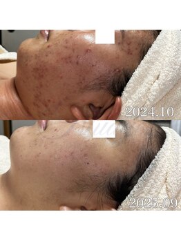 ニュアージュ(Nuage)/30代代女性/ニキビケアの変化