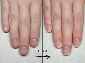 ユユネイル(yuyu nail)/【深爪育成】1ヶ月経過