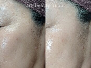 アート ビューティールーム(art beauty room)/XE'LHA PEEL （セラピール） 1回