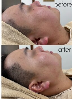 ルポ(Repos)/メンズエステシェービング