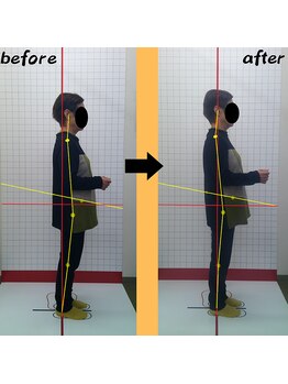 ほねつぎ 荒川沖はりきゅう接骨院/姿勢の変化3