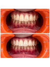 エクシアホワイトニング 日本橋店/人形町ホワイトニング