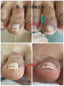 名古屋駅前巻き爪センター/巻き爪