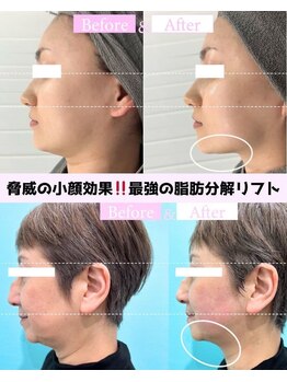 オンダリフト東京 大阪梅田店/マイクロリフト/梅田/ララピール