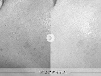 スパレーカ(Spa laka)/赤み・シミケア