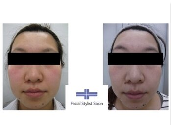 フェイシャルスタイリストサロン 四谷店/ケア例(51)