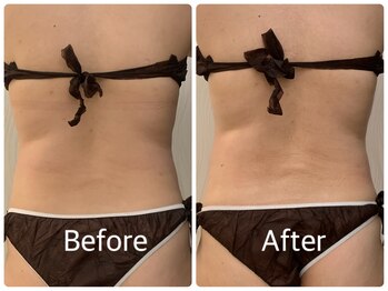 ソルニス(Solnis.)/痩身☆脂肪分解/ハイパーナイフ