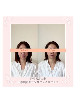 リフェイスフサエ(ReFace Fusae)/お顔の変化