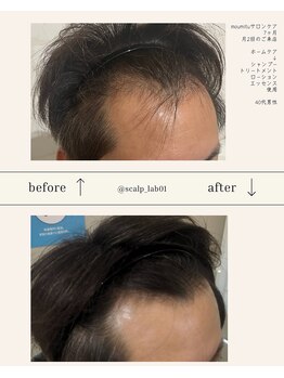 スカルプラボ 倉敷店(Scalp Lab)/moumitu7ヶ月症例